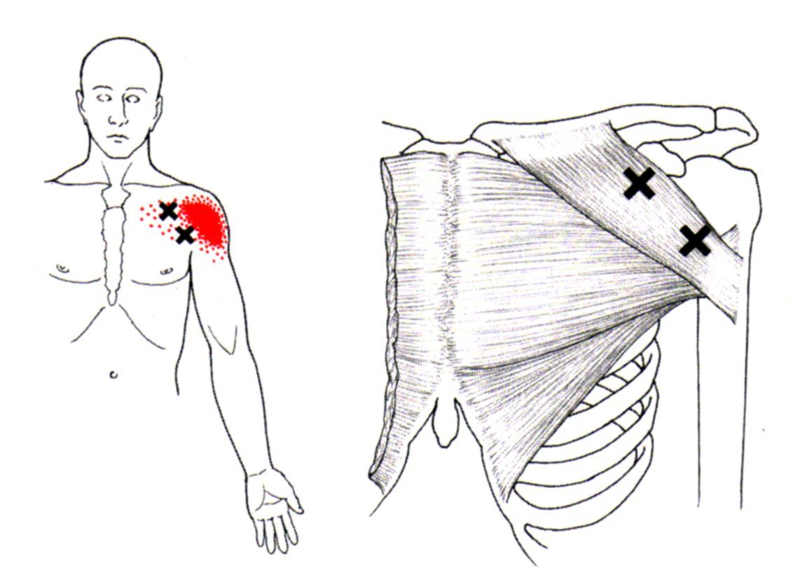 Pectoralis Major The Trigger Point & Referred Pain Guide